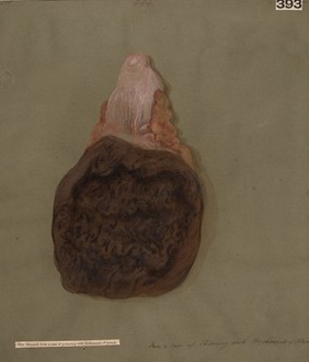 Stomach, with mucous membrane thickened and mammillated