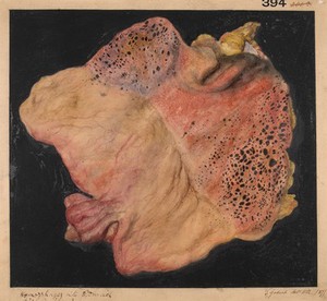 view Polypi of the mucous membrane of the stomach