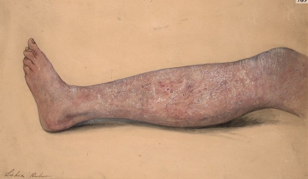 Leg affected with lichen ruber