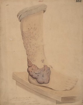 Leg and foot with extensive keloid growths in the cicatrices following a burn