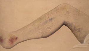 view Purpura haemorrhagica affecting the leg