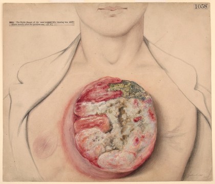 Scirrhous carcinoma of the breast