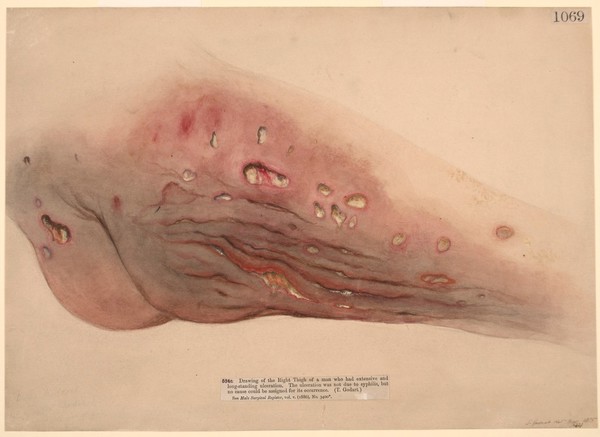 Thigh of a man with long standing ulceration