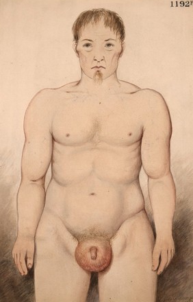 Man with diffuse lipoma affecting the groin and scrotum