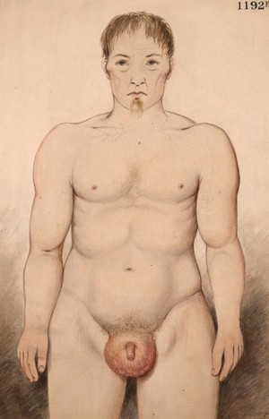 view Man with diffuse lipoma affecting the groin and scrotum