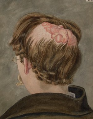 view Head of a man suffering from 'withering sarcoma' of the scalp