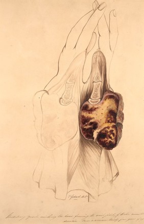 Medullary growth of the bones of the wrist joint