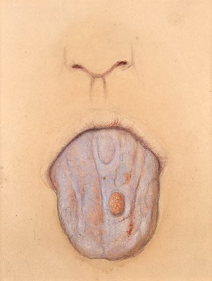 view Leucoma and wart on the tongue