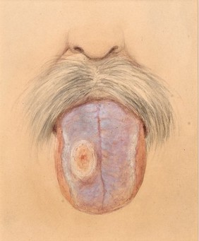 Leucoma and epithelioma of the tongue