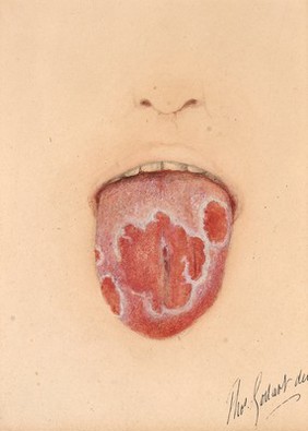 Tongue of a boy with 'wandering rash'