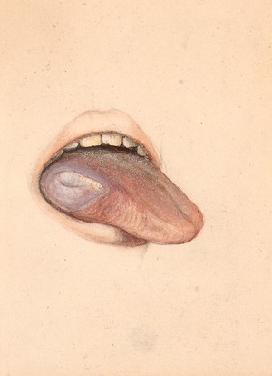 view Mucous patch on the tongue of a man suffering from secondary syphilis