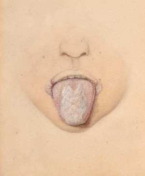 view Mucous patch on the tongue of a child with congenital syphilis