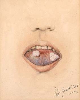 Condylomata on the tongue of a man suffering from secondary syphilis