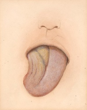 view Hemi-atrophy of the tongue