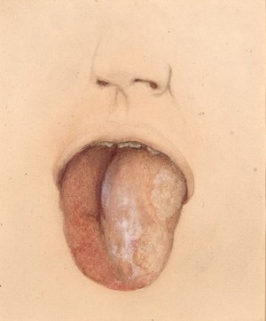 view Inflammatory hypertrophy of the tongue