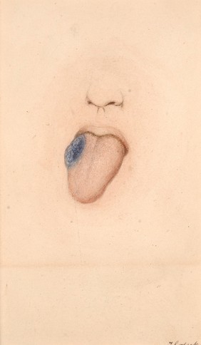 Naevus on the tongue