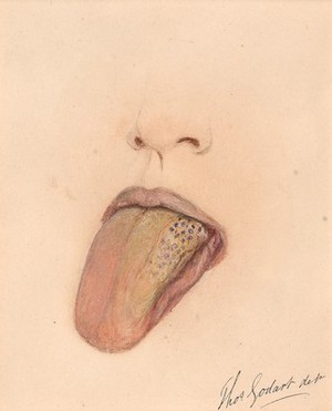 view Degenerated naevus on the tongue