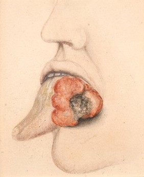 Fungating squamous-celled carcinoma of the tongue