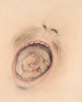 Squamous celled carcinoma of the tongue