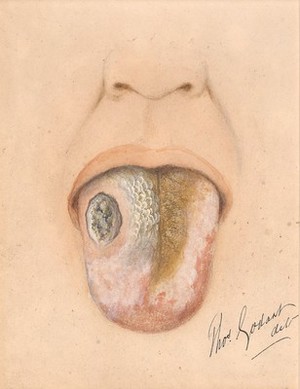 view Epithelioma and ichthyosis of the tongue