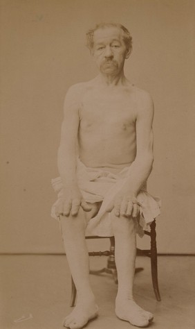 Male patient suffering from acromegaly