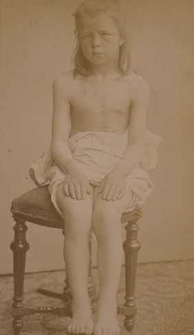 Young girl suffering from acromegaly