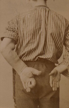 Hands of a patient suffering from acromegaly