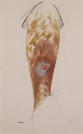 Ulceration of the leg