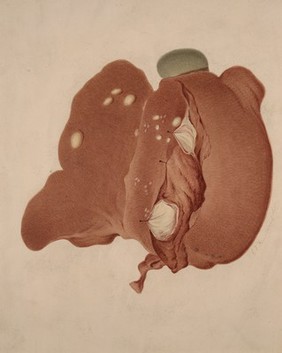 Polycystic liver