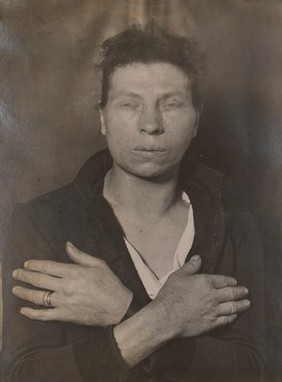 Face and hands of woman, possibly suffering from myxoedema