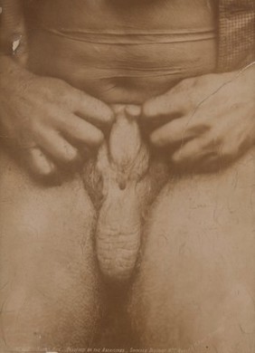 Scrotum of an Australian Aborigine who has undergone ceremonial penile subincision