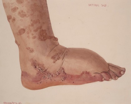 Foot of a man suffering from Hebra's sarcoma melanoides