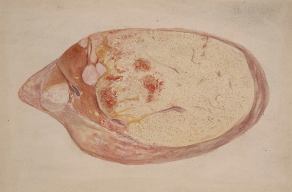 Ovarian cyst