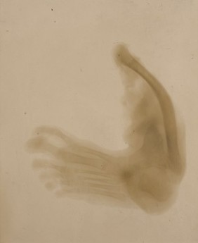 Skiagram of a foot with supernumerary great toe