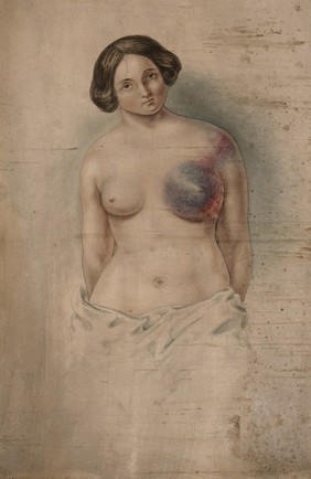 Woman suffering from cancer of the left breast