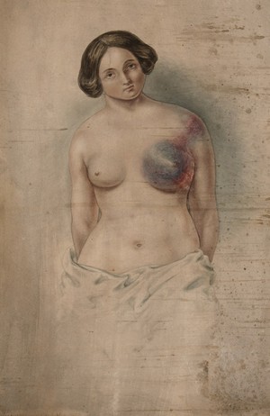view Woman suffering from cancer of the left breast