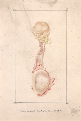 Varicose lymphatic vessel of the spermatic cord