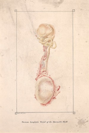 view Varicose lymphatic vessel of the spermatic cord