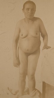 Woman affected with a swollen abdomen