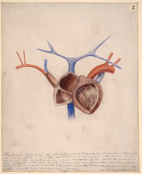 Fused hearts of a two-headed foetus (dicephalus dibrachius)