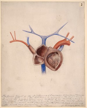 view Fused hearts of a two-headed foetus (dicephalus dibrachius)