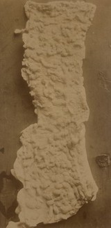 Section of intestine with polyposis coli