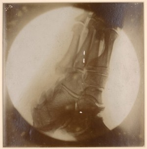 view Skiagram of the ankle of a patient with acromegaly