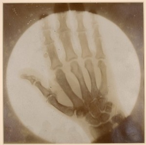 view Skiagram of the right hand of a patient with acromegaly