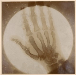 Skiagram of the right hand of a patient with acromegaly