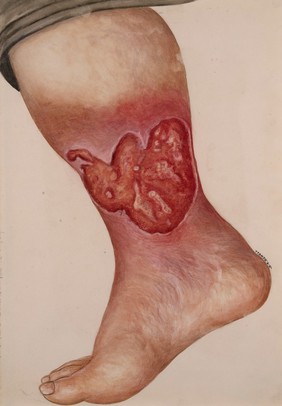 Ulceration around the ankle