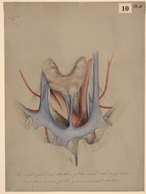 view Great vessels at the base of the neck showing an irregular course of the innominate artery