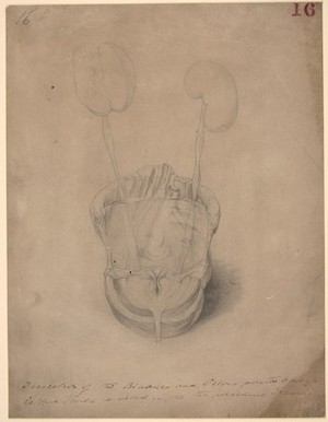 view Dissection of the bladder and pelvis from a case of ectopia vesicae