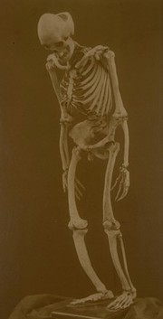 Skeleton with osteitis deformans