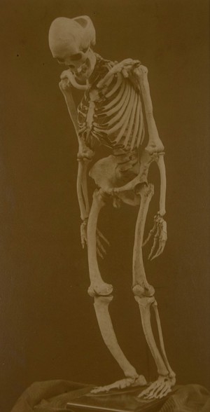 view Skeleton with osteitis deformans